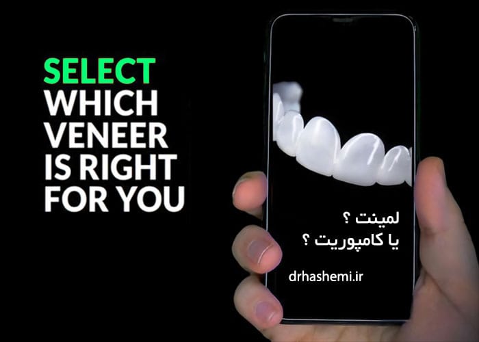 لمینت یا کامپوزیت