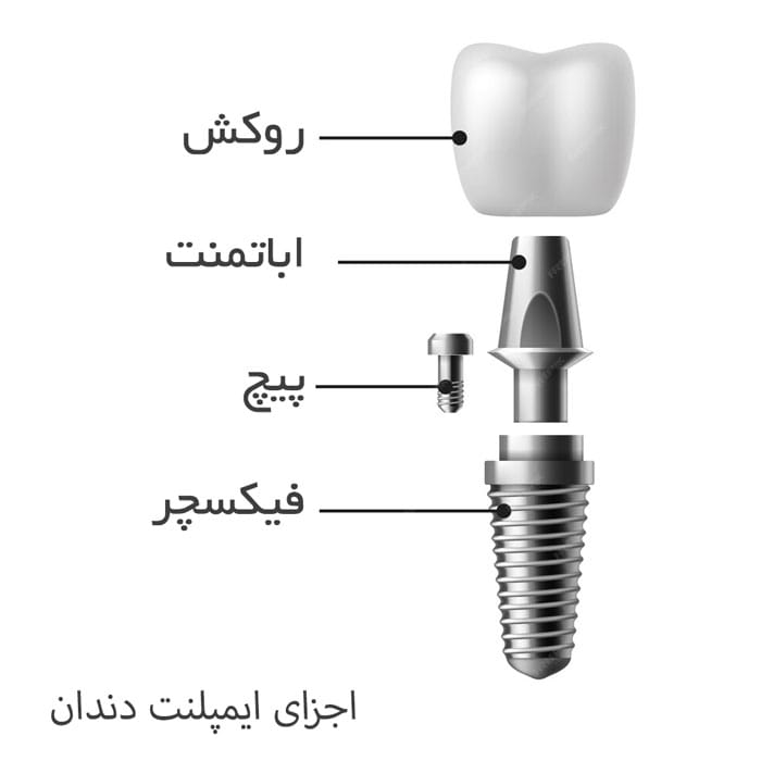 بهترین نوع ایمپلنت دندان