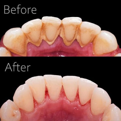 قبل و بعد جرمگیری دندان