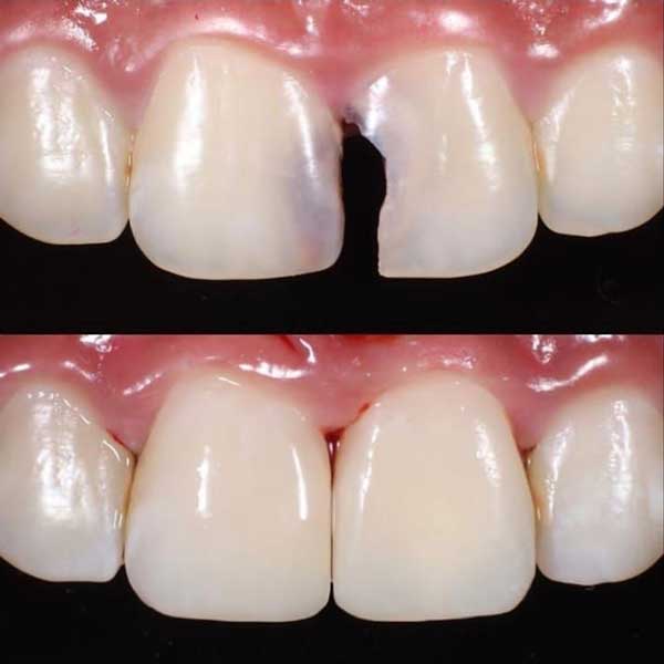 ترمیم دندان