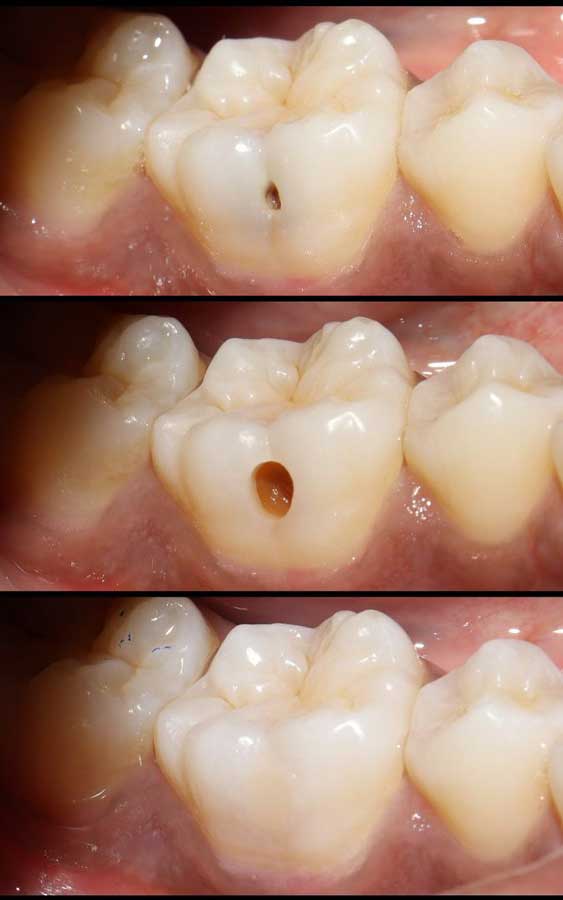 قبل و بعد پر کردن دندان