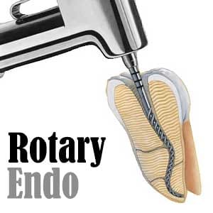 عصب کشی با دستگاه روتاری