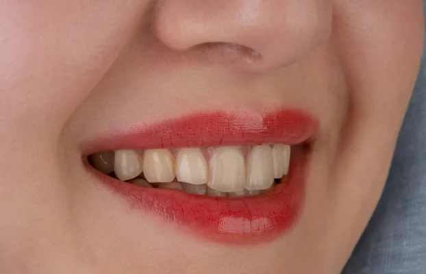 چگونه از زرد شدن کامپوزیت دندان جلوگیری کنیم؟