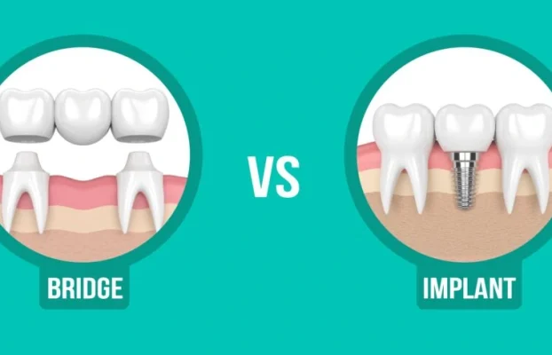 ایمپلنت بهتر است یا بریج؟ یک مقایسه جامع