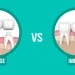 ایمپلنت بهتر است یا بریج؟