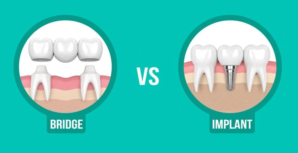 ایمپلنت بهتر است یا بریج؟ یک مقایسه جامع