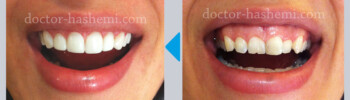لیفت لثه + کامپوزیت دندان لیفت لثه