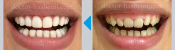 لیفت لثه + کامپوزیت دندان لیفت لثه