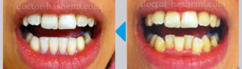 لیفت لثه + کامپوزیت دندان + بلیچینگ لیفت لثه
