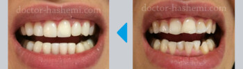 لیفت لثه + لمینت دندان لیفت لثه