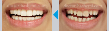 لیفت لثه + لمینت دندان لیفت لثه